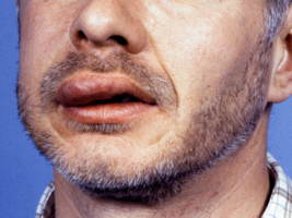 Face showing CSU-related swelling with a visibly enlarged upper lip.