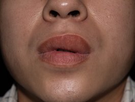 Face showing CSU-related swelling on the lips.