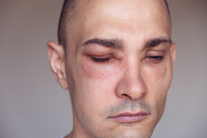 Photo of a person with eyes swollen shut.