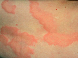 Close-up of torso skin with red, irregular hive patches.