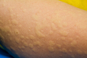 Close-up of an arm showing clustered hives appearing as small, raised bumps.