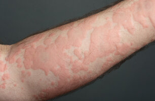 Close-up of an arm covered in large, red, raised hives.